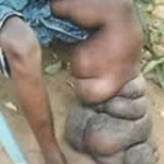 a66_Elephantiasis2