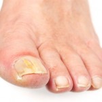 a98376_rsz_toenail-fungus