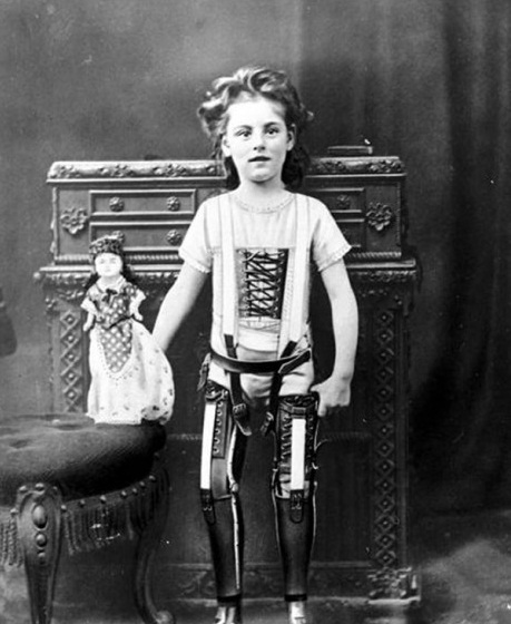 19-A-kid-with-his-artificial-legs-1898
