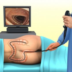 Colonoscopy-604×400