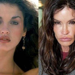 celebrity_surgeries_that_didnt_end_well_640_11