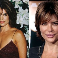 celebrity_surgeries_that_didnt_end_well_640_16