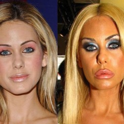 celebrity_surgeries_that_didnt_end_well_640_22