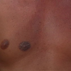 third-nipple