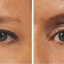 Want-an-Eye-Lift-Without-Surgery-You’ll-Need-2-Minutes-Only-Here-is-how