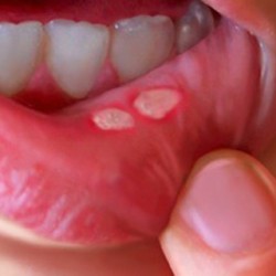cankersore_Mouth_ulcer