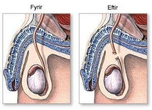 Fyrir og eftir herraklippingu