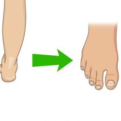 5-ways-to-naturally-shrink-your-bunions-without-surgery-1