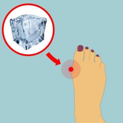 5-ways-to-naturally-shrink-your-bunions-without-surgery-3