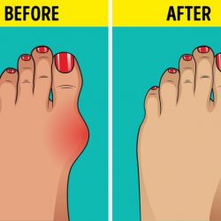 5-ways-to-naturally-shrink-your-bunions-without-surgery-4