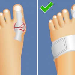 5-ways-to-naturally-shrink-your-bunions-without-surgery-5